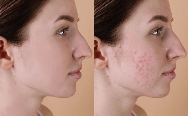 Acne Facials vs. Regular Facials: What’s the Difference? - Beauty Logix